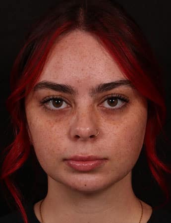 After Image: Buccal Fat Removal - front