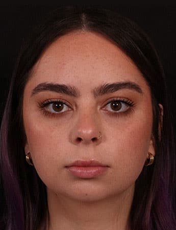 Before Image: Buccal Fat Removal - front