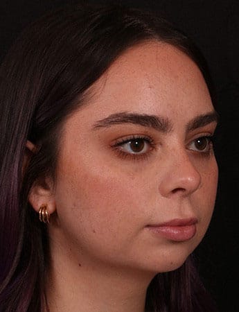 Before Image: Buccal Fat Removal - right-front-oblique