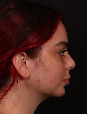 After Image: Buccal Fat Removal - right-side