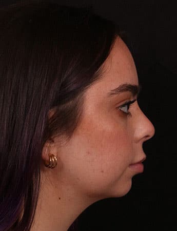 Before Image: Buccal Fat Removal - right-side