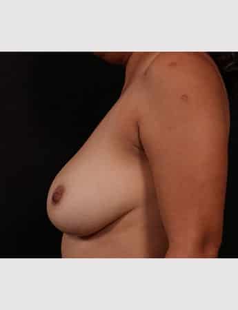 Before Image: Mastopexy (Breast Lift) - left-side