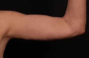 After Image: Brachioplasty (Arm Lift) - front