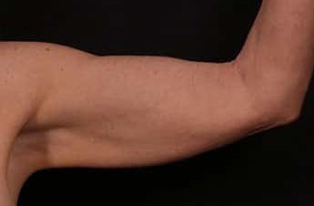 Before Image: Brachioplasty (Arm Lift) - front