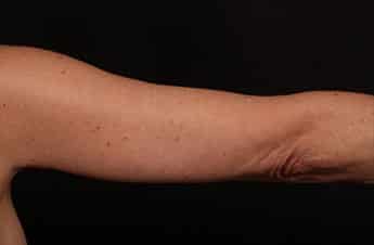 After Image: Brachioplasty (Arm Lift) - back