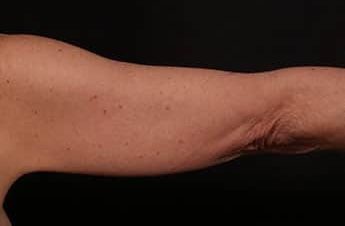 Before Image: Brachioplasty (Arm Lift) - back