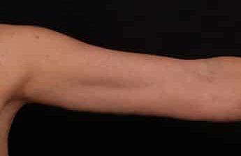 After Image: Brachioplasty (Arm Lift) - front