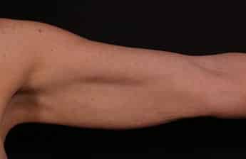 Before Image: Brachioplasty (Arm Lift) - front