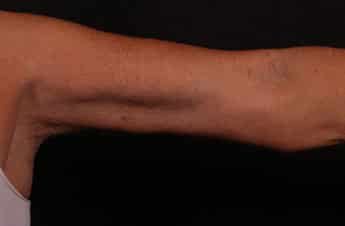 After Image: Brachioplasty (Arm Lift) - front
