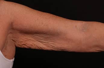 Before Image: Brachioplasty (Arm Lift) - front