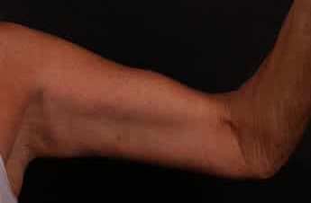 After Image: Brachioplasty (Arm Lift) - front