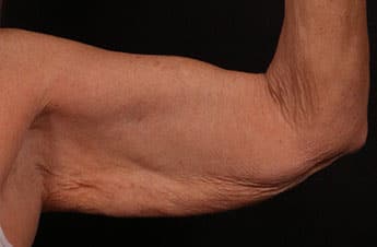 Before Image: Brachioplasty (Arm Lift) - front