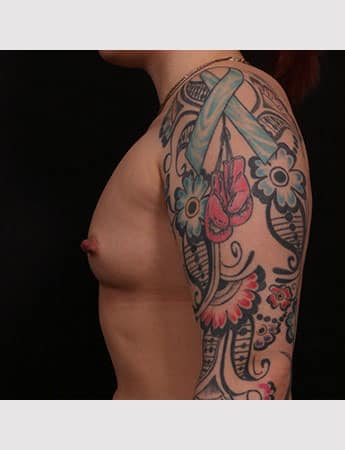 Before Image: Breast Augmentation - left-side