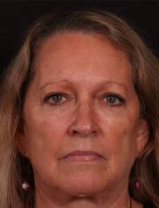 Blepharoplasty
