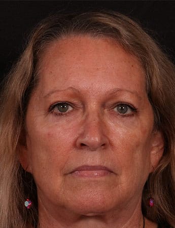 After Image: Blepharoplasty - front