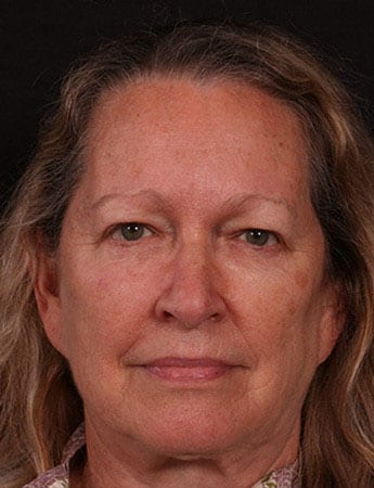 Before Image: Blepharoplasty - front