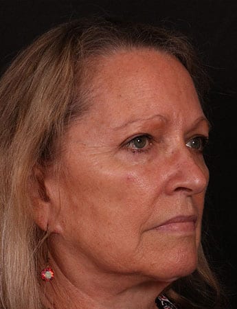 After Image: Blepharoplasty - right-front-oblique