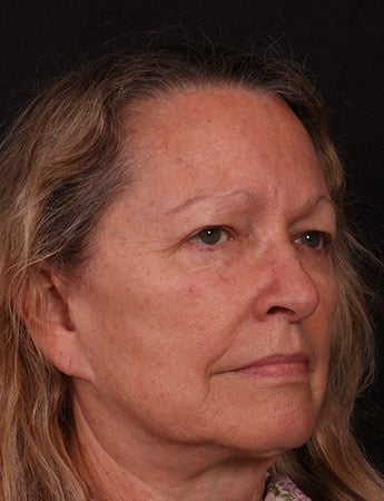 Before Image: Blepharoplasty - right-front-oblique