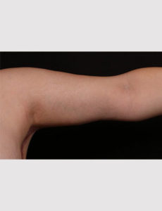 Brachioplasty (Arm Lift)