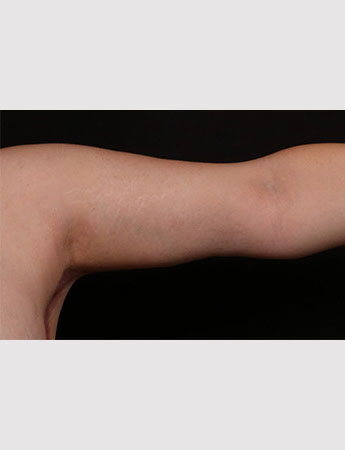 After Image: Brachioplasty (Arm Lift) - front
