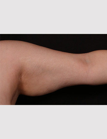Before Image: Brachioplasty (Arm Lift) - front