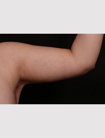 After Image: Brachioplasty (Arm Lift) - front