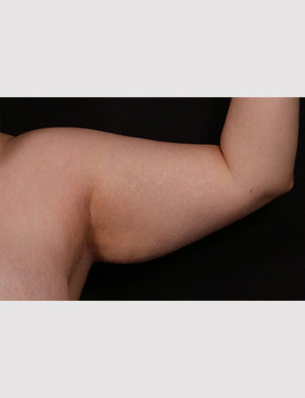 Before Image: Brachioplasty (Arm Lift) - front