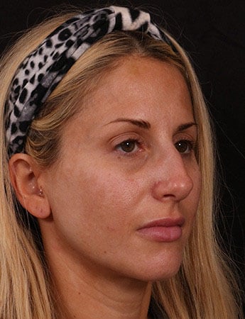 Before Image: Rhinoplasty - right-front-oblique