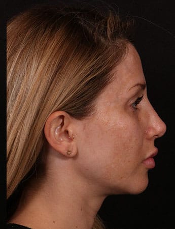 After Image: Rhinoplasty - right-side