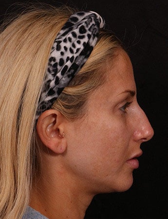Before Image: Rhinoplasty - right-side