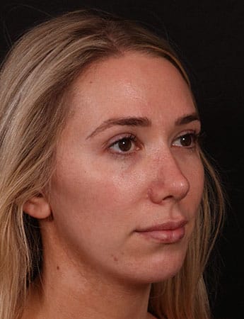 After Image: Rhinoplasty - right-front-oblique