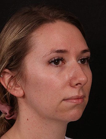 Before Image: Rhinoplasty - right-front-oblique