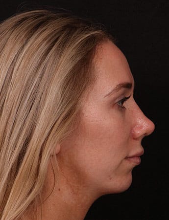 After Image: Rhinoplasty - right-side