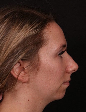 Before Image: Rhinoplasty - right-side