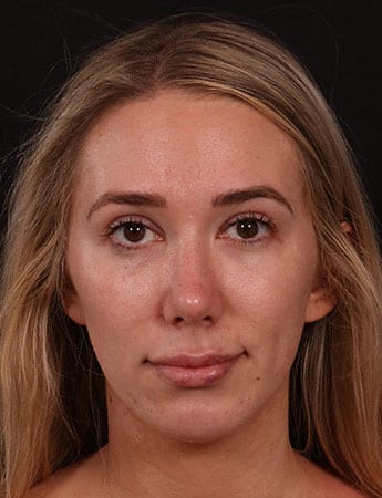 After Image: Chin Implant - front