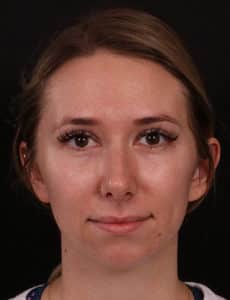 Before Image: Chin Implant