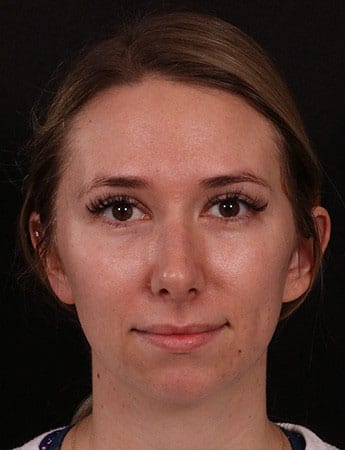 Before Image: Chin Implant - front