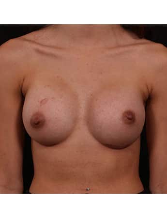 After Image: Breast Augmentation - front
