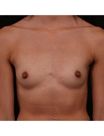 Before Image: Breast Augmentation - front