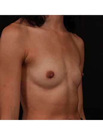 Before Image: Breast Augmentation - right-front-oblique