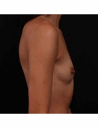 Before Image: Breast Augmentation - right-side