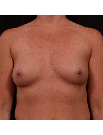 Before Image: Breast Augmentation - front