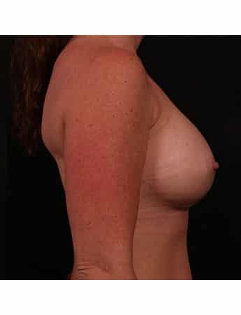 After Image: Breast Augmentation - right-side