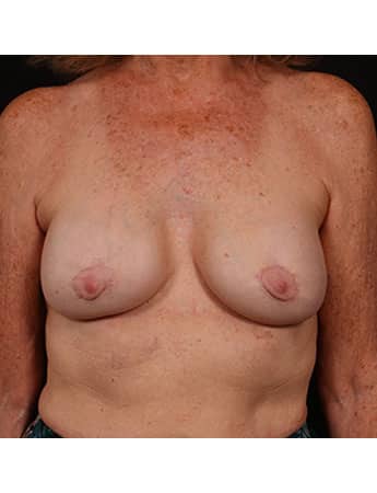 After Image: Secondary Breast Enhancement - front