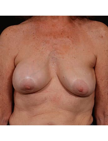 Before Image: Secondary Breast Enhancement - front