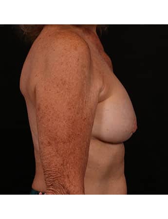 After Image: Secondary Breast Enhancement - right-side
