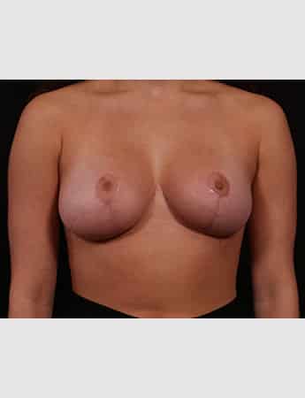 After Image: Breast Reduction - front