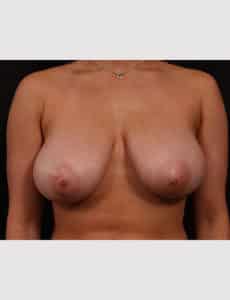 Before Image: Breast Reduction