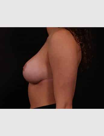 After Image: Breast Reduction - left-side