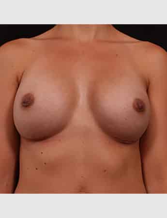 After Image: Breast Augmentation - front